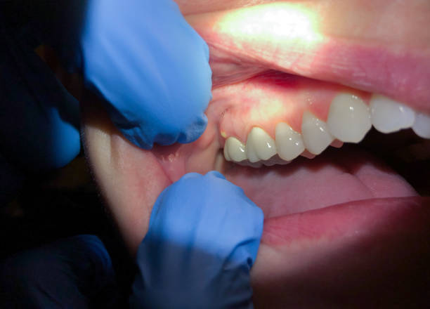Best Emergency Root Canal Treatment in Coats, NC